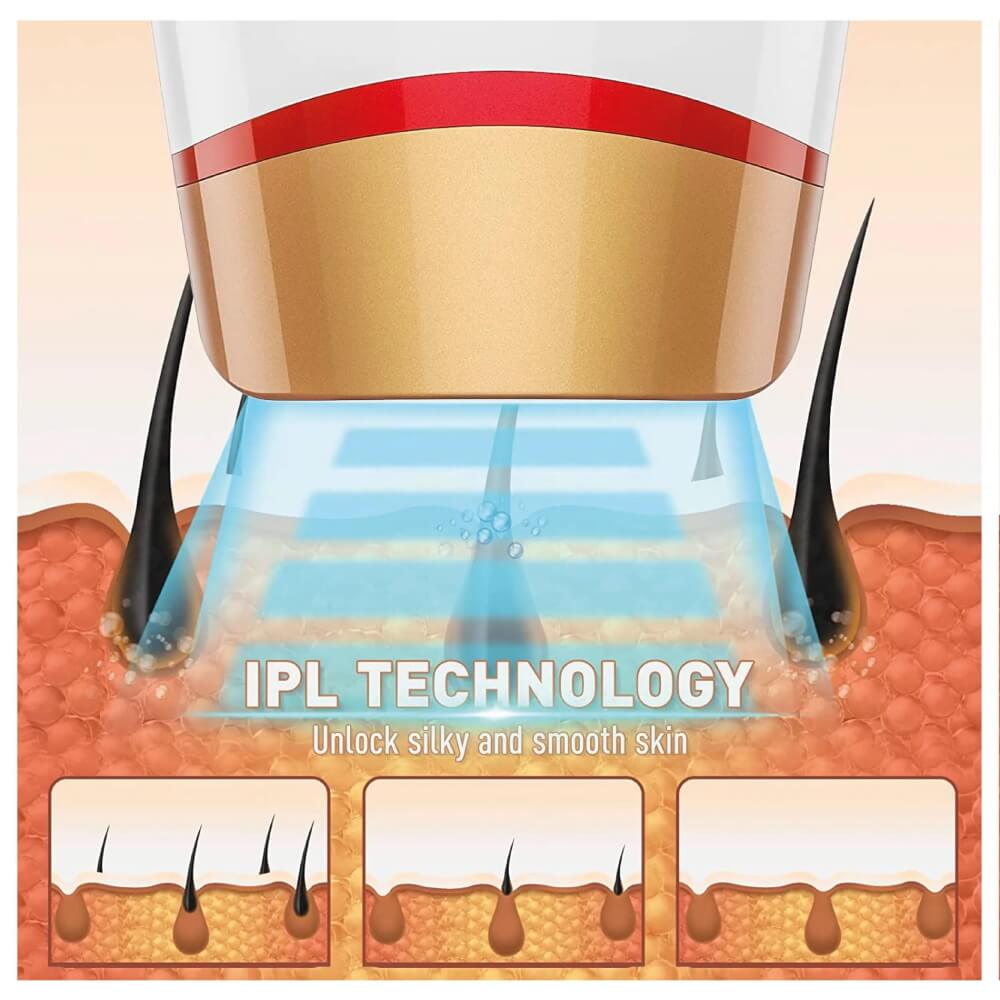 מסיר שיער ביתי medics care ipl
